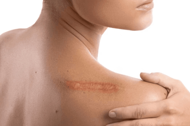 skin-scars
