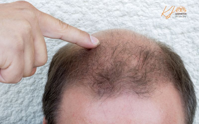 hairloss