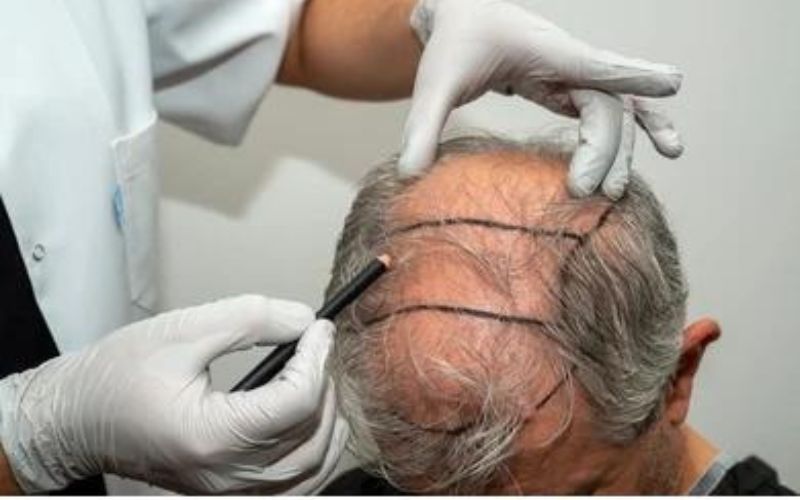 Hair Transplant