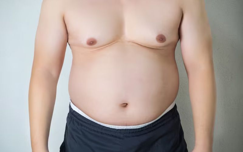 Gynecomastia