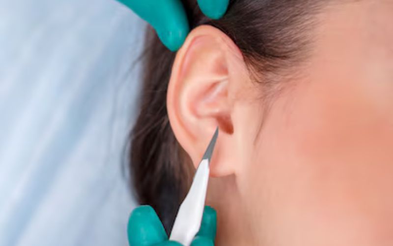 Otoplasty (Ear Surgery)