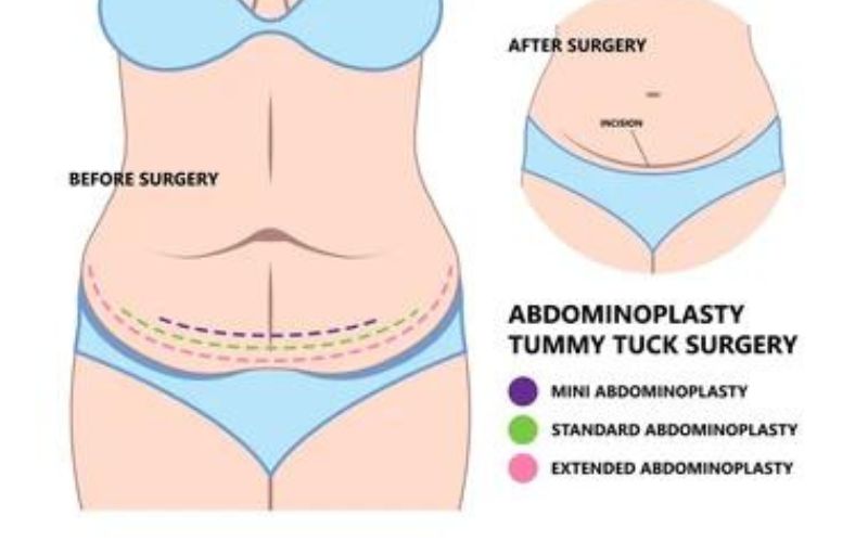 Abdominoplasty