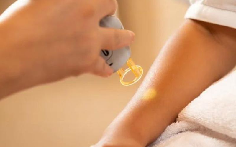 Benefits of Laser Hair Removal Treatment